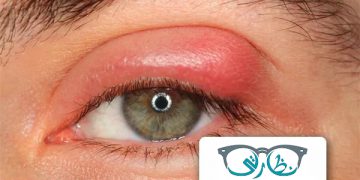 الكيس الدهني فى العين