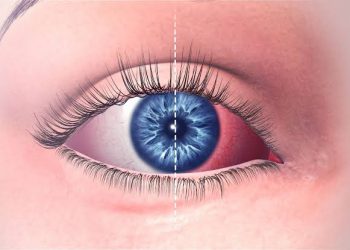 الرمد الربيعي- حساسيه الربيع