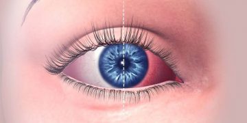 الرمد الربيعي- حساسيه الربيع