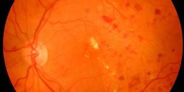 تأثير مرض السكر على شبكية العين