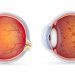 بما تنصح مريض لديه التهاب الشبكية الصباغي (Retinitis Pigmentosa)
