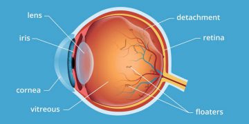 الذبابة الطائرة في العين