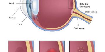 التنكس البقعي