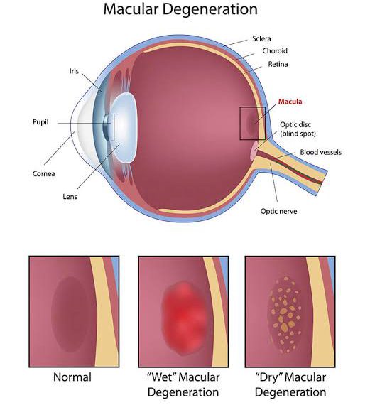 التنكس البقعي