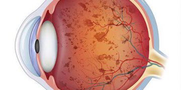 الْتِهابُ الشَّبَكِيَّةِ الصِّباغِيّ