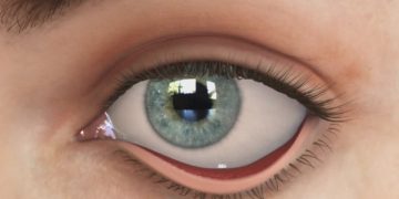 الشتر الجارجي Ectropion