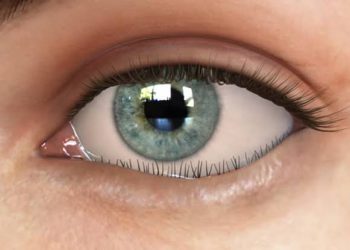 الشتر الداخلي Entropion