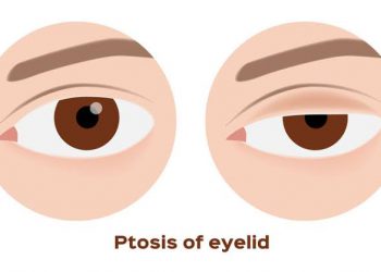 انسدال الجفن (تهدل) Ptosis