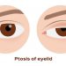 انسدال الجفن (تهدل) Ptosis