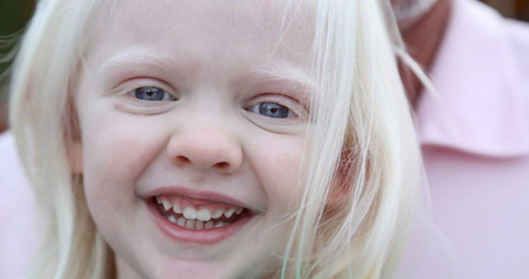 المهق (الجنجر) Albinism