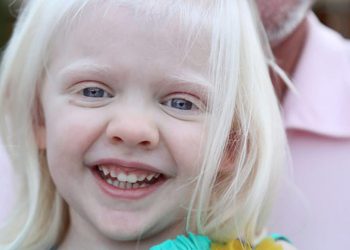 المهق (الجنجر) Albinism