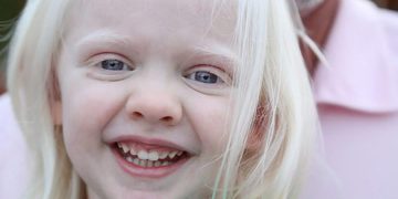 المهق (الجنجر) Albinism