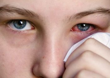 التهاب الملتحمة Conjunctivitis