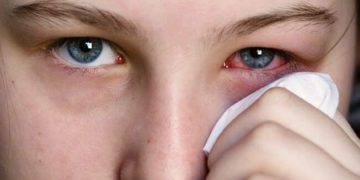 التهاب الملتحمة Conjunctivitis
