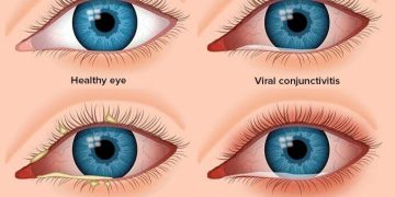 العين الحمراء (إحمرار العين) Pink eye