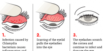 مراحل تطور الإصابة بالتراخوما