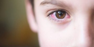 الرمد الربيعي Spring catarrh