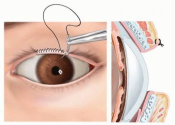 نقص الجفن palpebral coloboma