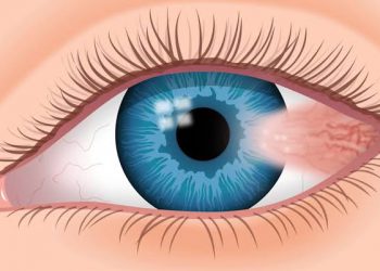 الظفرة Pterygium