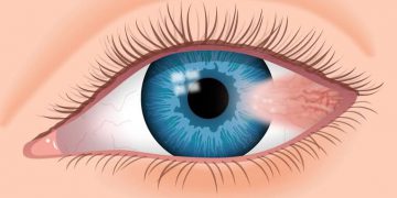 الظفرة Pterygium
