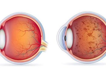 التهاب الشبكية الصباغي Retinitis Pigmentosa