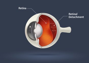 انفصال الشبكية Retinal detachment