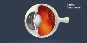 انفصال الشبكية Retinal detachment