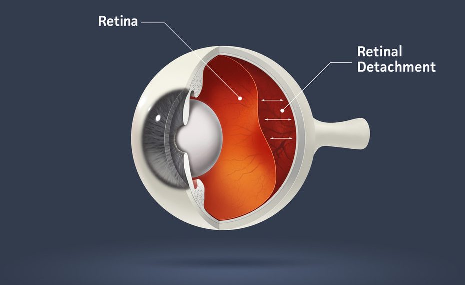 انفصال الشبكية Retinal detachment