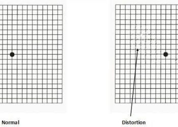 اختبار لوحة أمسلر Amsler test chart