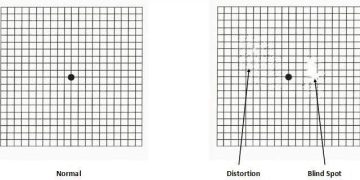 اختبار لوحة أمسلر Amsler test chart