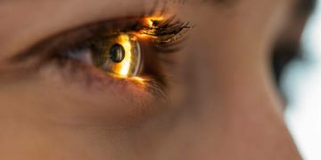 وذمة القرنية Corneal Oedema