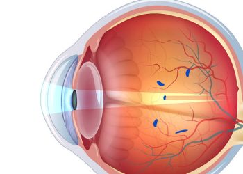 الأجسام الطافية والوميض Floaters and Flashes