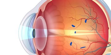 الأجسام الطافية والوميض Floaters and Flashes