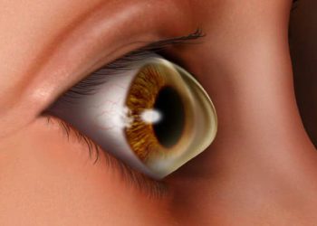 Management of Keratoconus Course videos