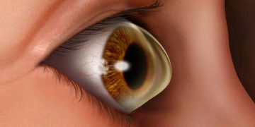 Management of Keratoconus Course videos