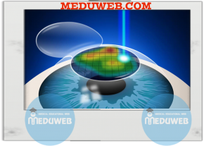 Refractive laser preoperative assessment