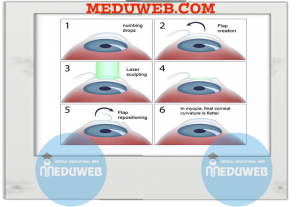 Refractive laser preoperative assessment