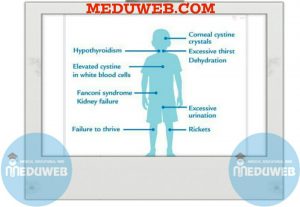 Cystinosis
