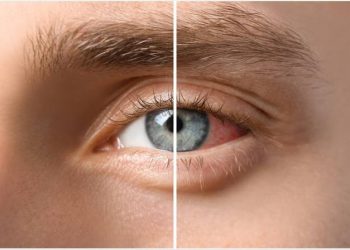 Drug-induced uveitis