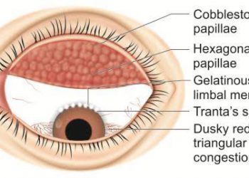 Atopic keratoconjunctivitis diagnosis and treatment