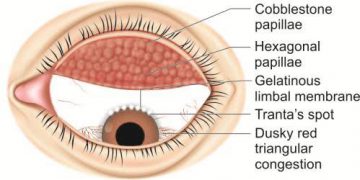 Atopic keratoconjunctivitis diagnosis and treatment