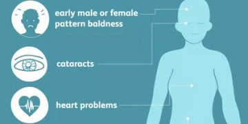 Myotonic dystrophy ocular and systemic capsule