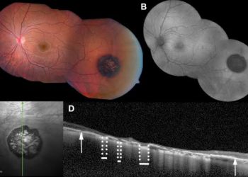 CHRPE ( congenital hypertrophic RPE)