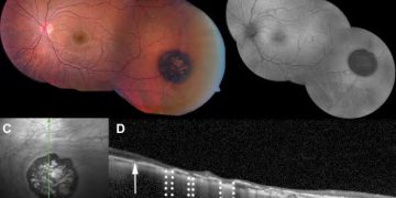 CHRPE ( congenital hypertrophic RPE)