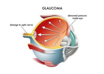 Normal Tension glaucoma (NTG) capsule