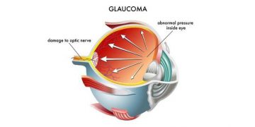 Normal Tension glaucoma (NTG) capsule