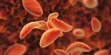 Ocular Toxoplasmosis