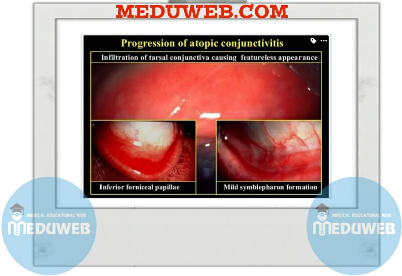 Atopic keratoconjunctivitis