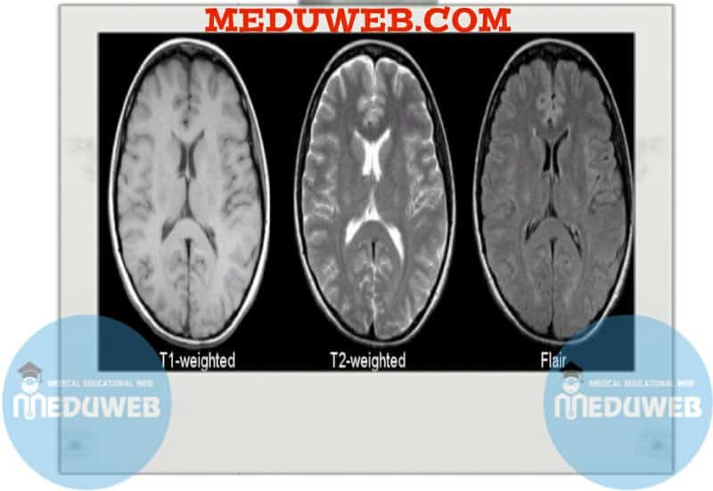 T-weighted MRI