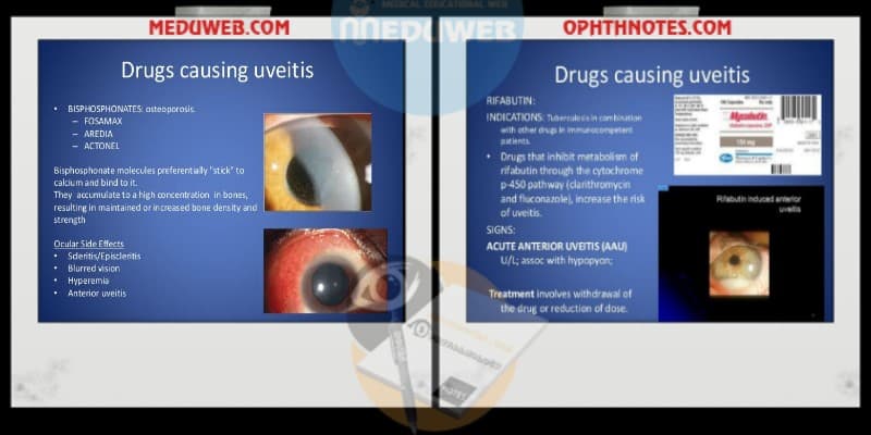 Drug-induced uveitis